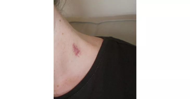 How To Get Rid Of Hickeys