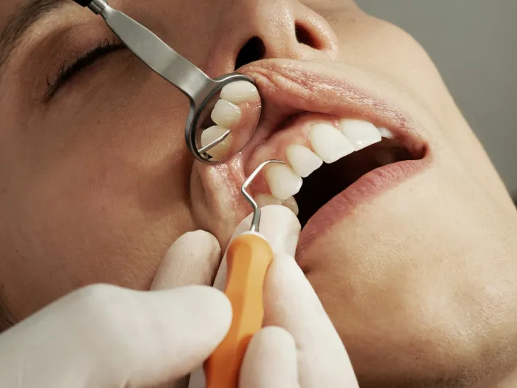 Root Canal Treatment in Gorakhpur