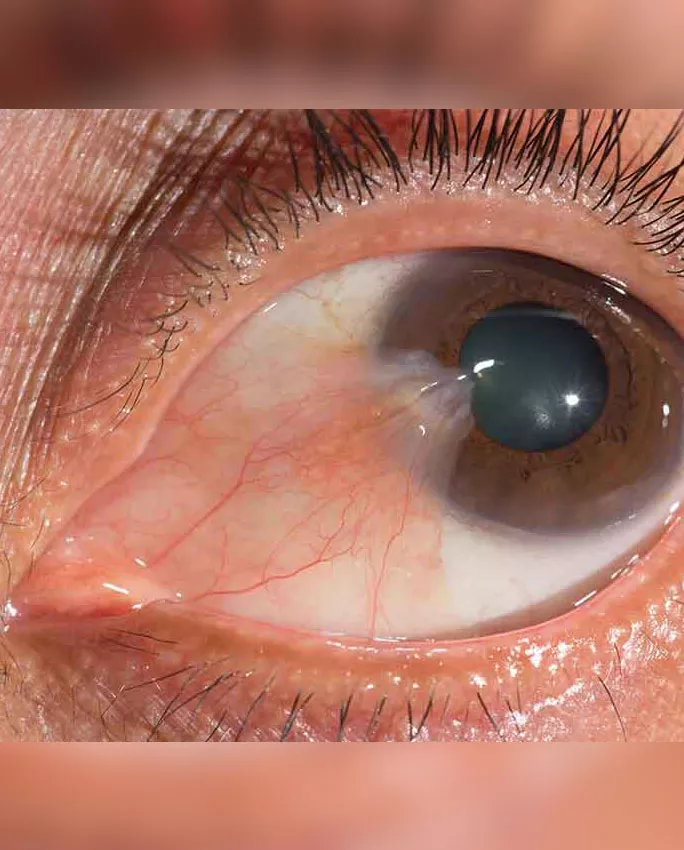 pterygium growth dr swati sinkar adelaide 