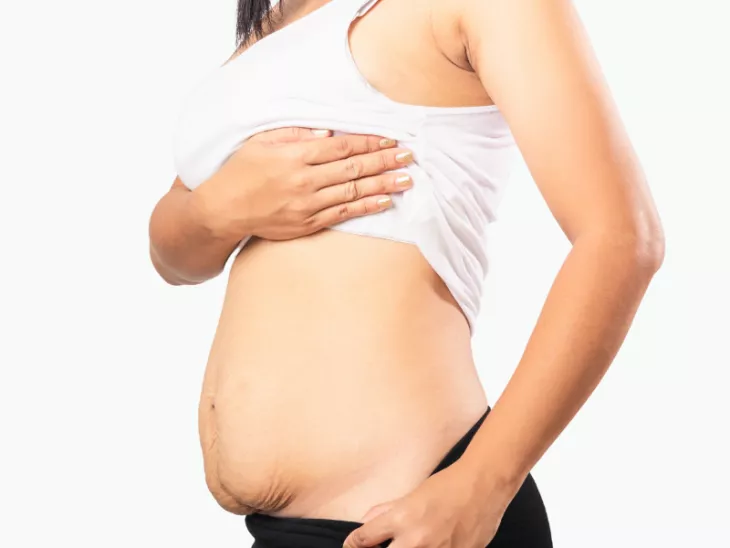 Tummy Tuck After Pregnancy for a Confident You