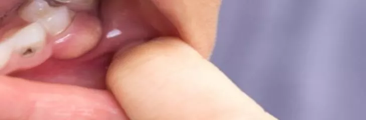wisdom tooth surgeons utah