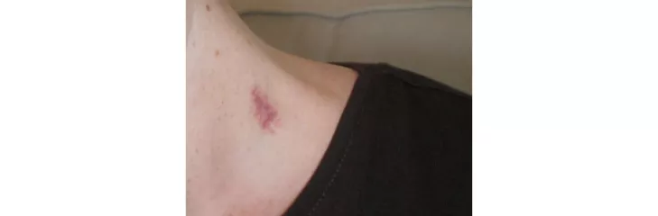 How To Get Rid Of Hickeys