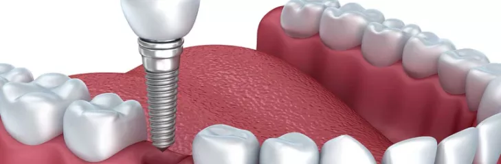 Dental Implants