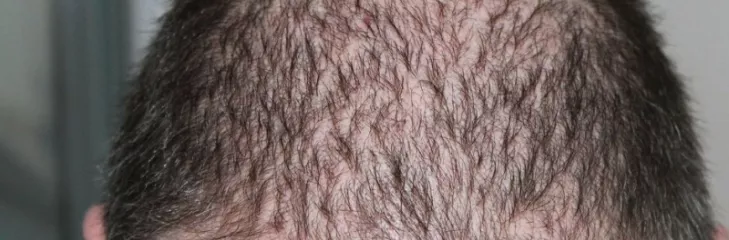 Want to connect with a relevant Hair Transplant Clinic in London to manage your hair loss!