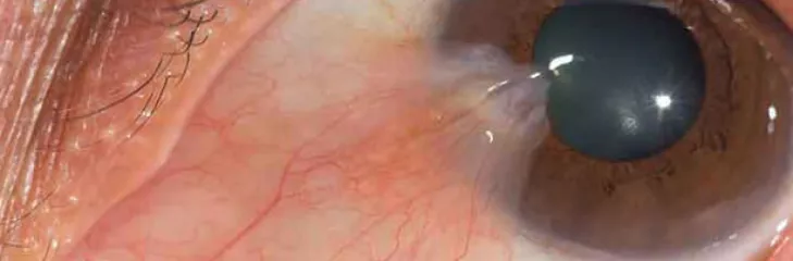 pterygium growth dr swati sinkar adelaide 