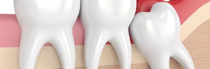 Wisdom Tooth Removal in Olney
