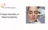 blepharoplasty