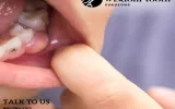 wisdom tooth surgeons utah