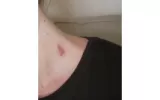 How To Get Rid Of Hickeys