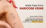  Varicose Veins