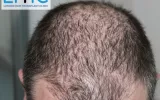 Want to connect with a relevant Hair Transplant Clinic in London to manage your hair loss!