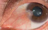 pterygium growth dr swati sinkar adelaide 