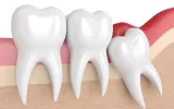 Wisdom Tooth Removal in Olney